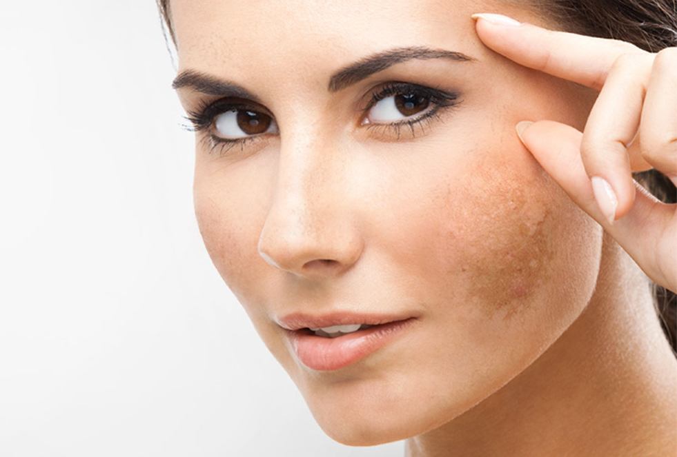 Melasma – Tudo o que você precisa saber